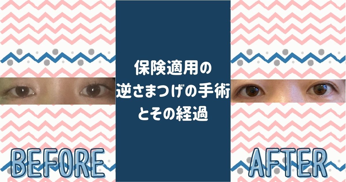 保険適用の逆さまつげの手術 全切開の二重形成術 とその経過 ウサブログ